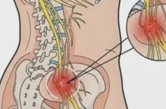 Illustration of the lumbar spine and sciatic nerve